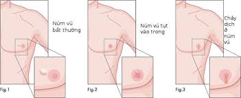 Ung thư vú ở nam giới - Hình ảnh minh họa